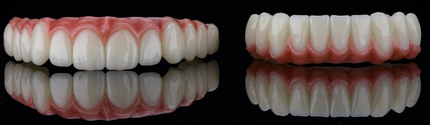 Full Mouth Rehabilitation