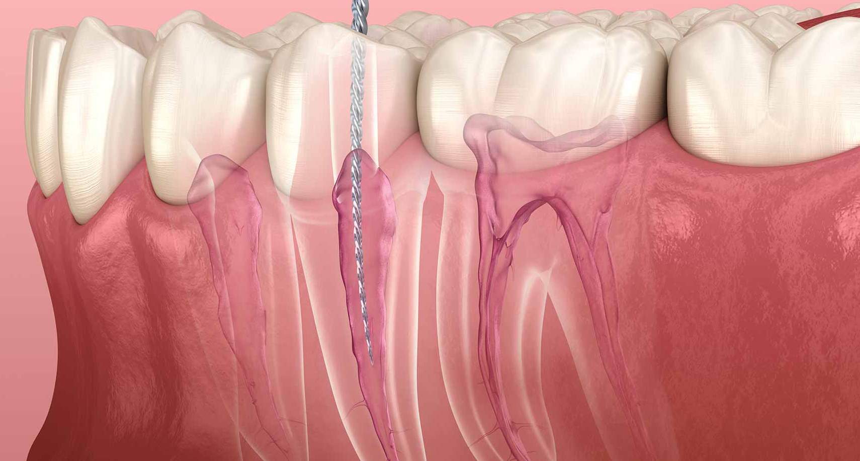 Root Canal Treatments