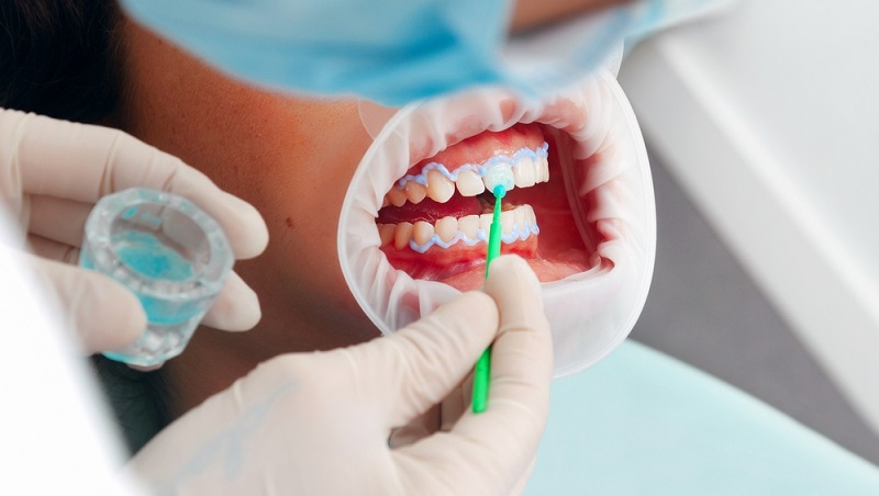 Teeth Whitening