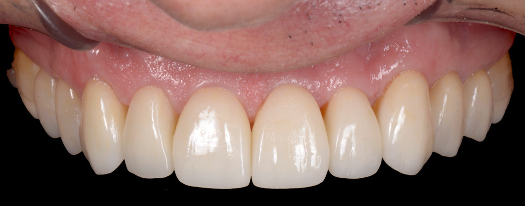 Zirconia